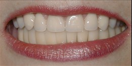dental implants after dr jason denise annapolis maryland