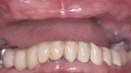 dental implants before dr jason denise annapolis maryland