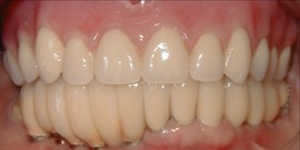 dental implants progress dr jason denise annapolis maryland