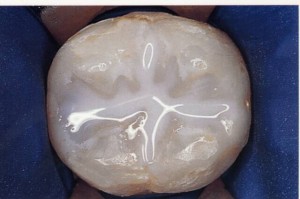 Sealants, Dentist Annapolis