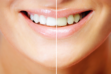 tooth whitening services annapolis