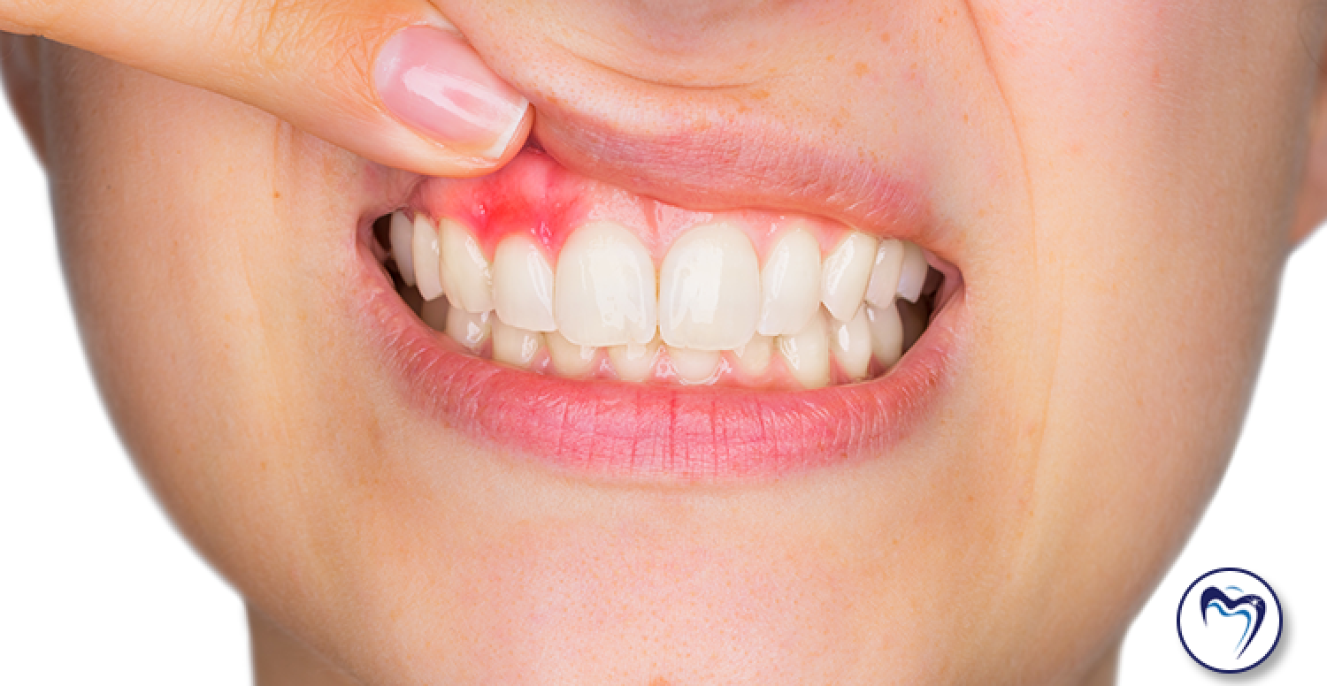 Abscessed Tooth: Causes, Symptoms, and Treatment
