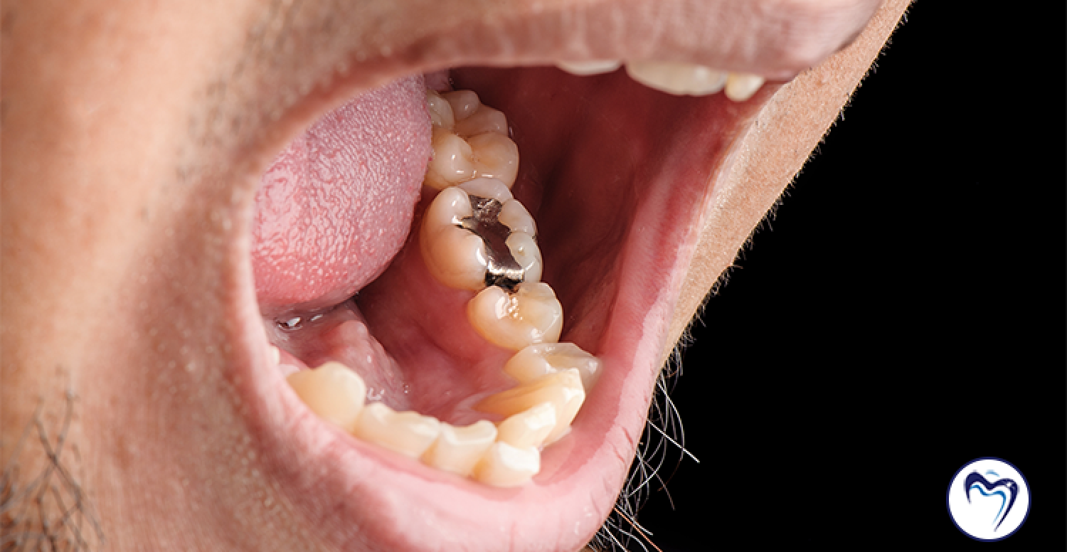 Do Old Silver Amalgam Fillings Need to Be Replaced?